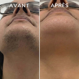 KyraGlow — Enfin une peau lisse sans repousses Kyrasanté